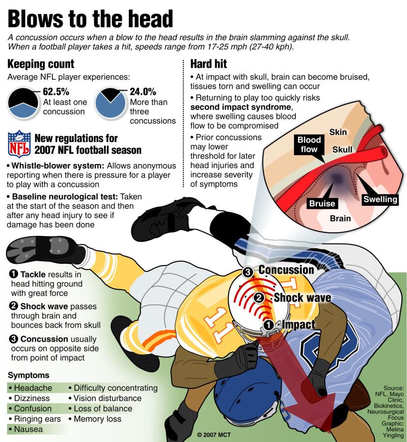 A graphic explaining what happens when a football player receives a blow to the head. 

07000000, 15000000, HTH, krthealth health, krtnational national, krtsports sports, SPO, krt, blood flow, blow, brain, bruise, chart, concussion, dementia, depression, head, headache, hit, impact, neurological, player, regulations, season, second impact, shock wave, skull, swelling, tackle, 2007, krt2007, mctgraphic, 07009000, 07018000, HEA, injury, krtmedicine medicine medical, medical condition, 15003000, 15003001, FBC, FBN, krtfootball football, krtncaafootball ncaa college, krtnfl nfl national football league, krtussports, u.s. us united states, african american african-american black, krtdiversity diversity, youth, krtnamer north america, USA, krt mct, yingling,